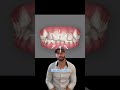 How Does Invisalign Work: Another Case Review. 2023