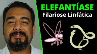 Elefantíase (Filariose Linfática) | Wuchereria bancrofti (Filária) | Curso de Parasitologia Humana