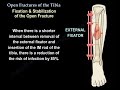 open fractures of the tibia everything you need to know dr. nabil ebraheim