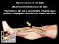 Open Fractures Of The Tibia  - Everything You Need To Know - Dr. Nabil Ebraheim