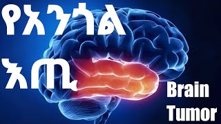 ተ.ቁ 14 - የአንጎል እጢ Brain tumor የአንጎል ሴል / ህዋስ ባልተለመደ አስተዳደግ አድጎ መብዛት ከሚገባው በላይ  በዝቶ አንጎል ላይ ሲሰባሰብ እና