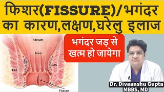 फिशर(भगंदर) के कारण,लक्षण,घरेलु इलाज बचाव,Fissure symptoms and cure, Fissure treatment at Home Hindi