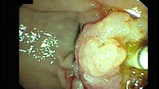 Case of Papilla Adenoma in periampullary diverticulum