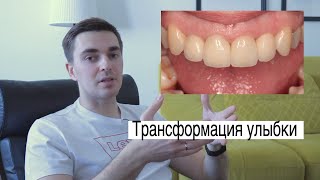 Трансформация улыбки. Виниры. Полный разбор клинического случая на карантине и самозоляции в Липецке