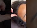 scatter scalp semipermanent hairline