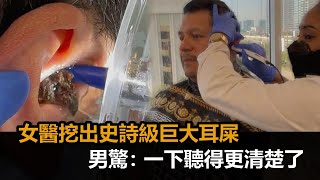 還以為是寄居蟹！女醫挖出「史詩級」巨大耳屎　男驚：一下聽得更清楚了－民視新聞