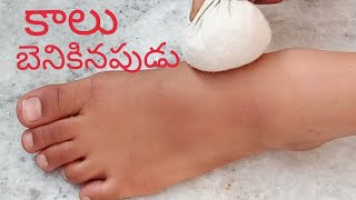 Ankle Sprain Treatment/Heel Pain Home Remedy/Heel Pain Treatment at Home/కాలు బెనికినపుడు ఇలా చేయండి