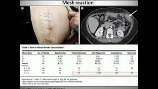 Biologic Mesh Should NOT Be Widely Applied: Shirin Towfigh, M.D.