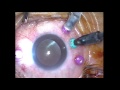 vitrectomy outviting the humor the art of vitreous removal in mobile retina dr manish nagpal