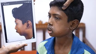 Lower Jaw Surgery for Brave Little Boy | An Amazing Results After Surgery