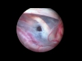 symptomatic grade 3 sylvian arachnoid cyst endoscopic fenestration