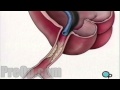 Stent Implantation Coronary Angioplasty PreOp® Patient Engagement and Education