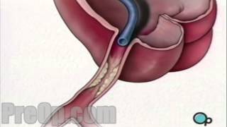 Stent Implantation Coronary Angioplasty PreOp® Patient Engagement and Education