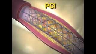 Trial of Everolimus Eluting Stents or Bypass Surgery for Coronary Disease