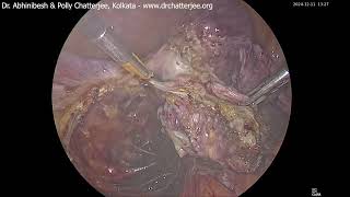 laparoscopic LSO for pelvic abscess and PID