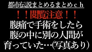 【閲覧注意】奇病で腹の中で何年も別の人間が育ち 髪の毛ボーボーの肉塊が出てきた衝撃写真…【難病】