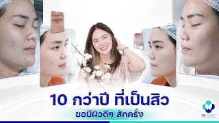 รักษาสิว | EP.156 | 10 กว่าปีที่เป็นสิว ต้องการรักษาให้หาย สักครั้งไหม? | BSL Clinic