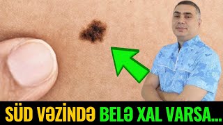 Qadınlar Diqqət! Döşünüzdə Belə Xallar Varsa... Epidermal Nevus