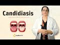 Candidiasis | Infectious Medicine Video Lectures | Online Medical Education | V-Learning