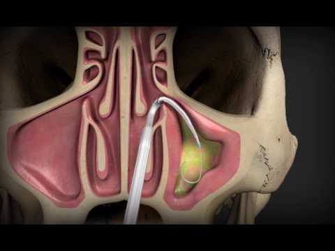 Balloon Sinuplasty - Learn How The Procedure Works - YouTube