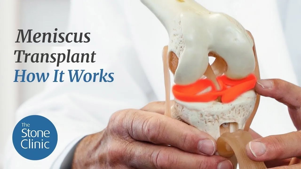 Meniscus Replacement - How It Works & What To Expect - YouTube