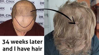 8 and a half month review | guess what happened | Dr Cinik Hair Transplant Turkey