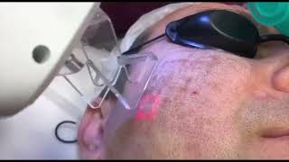 Laser resurfacing of post-acne using the More Xel CYMA device