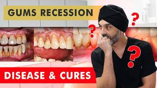 Gum Recession vs Gum Disease - and Treatments