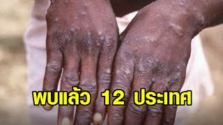 WHO ประชุมฉุกเฉินรับมือ 'ฝีดาษลิง' พบแล้ว 12 ประเทศ