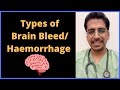 Types of Brain Haemorrhage! #neurology #icu #medicine #usmle #mrcp #plab #neetpg