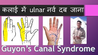 कलाई में ulnar नर्व दब जाना Guyon's Canal Syndrome (Hindi)