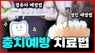 ※충치예방시술 추천※ 충치 예방에 효과적인 치료법 총정리❗️