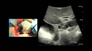 BK Medical: Intraoperative Ultrasound Imaging of the Liver