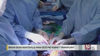 Braindead Huntsville Man Gets Pig Kidney Transplant