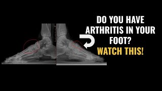 Do You Have Arthritis In The Middle Of Your Foot? WATCH THIS!