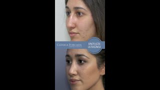 Rinoplastia Ultrasónica