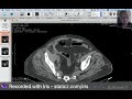 git emergency pneumoperitonium 1