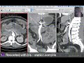 git emergency pneumoperitonium 1