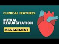 Mitral Regurgitation