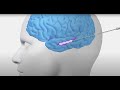 Laser Interstitial Thermal Therapy (LITT) for Epilepsy