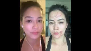 CBS4 Frances Wang Reveals Personal and Painful Skin Condition