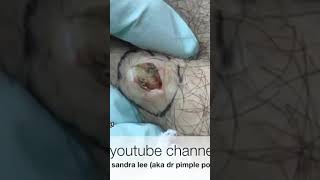 Pimple Popping Rehab | Dr. Pimple Popper #shorts #pimplepopping #cyst #shocking