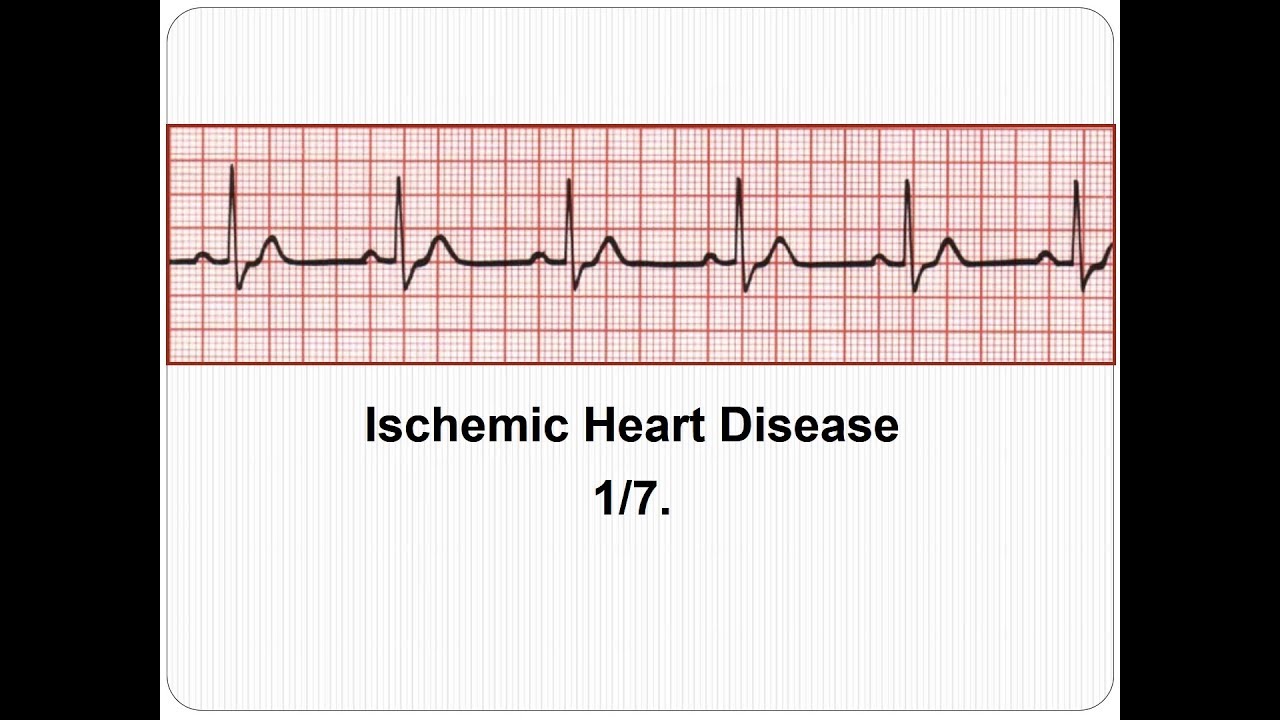 ECG Ischemic Heart Disease 1/7: Introduction - YouTube