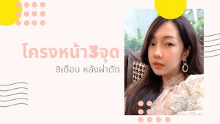 [รีวิวศัลยกรรมโครงหน้า] 8เดือน หลังผ่าตัด วีไลน์+โหนกแก้ม