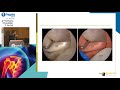 arthroscopic anatomy of the shoulder g. skarpas Όμιλος Υγεία