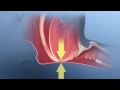 Obstructive Sleep Apnea Mayo Clinic
