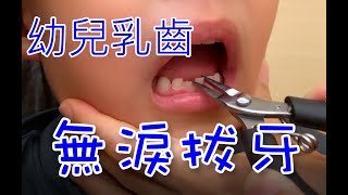 幼兒乳齒 無淚拔牙