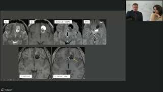 Вебинар: Синдром внемозговой кисты: дифференциальный диагноз на примере клинических случаев.