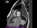 AIR Recon DL in Cardiac MRI