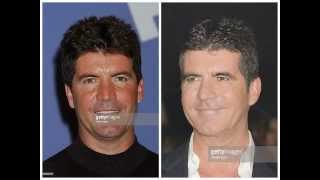Simon Cowell Botox Injections Before and After Photos
